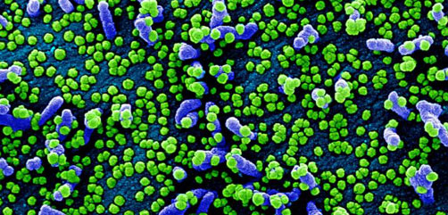 Colorized scanning electron micrograph of a VERO E6 cell (blue) heavily infected with SARS-COV-2 virus particles (green), isolated from a patient sample. Image captured and color-enhanced at the NIAID Integrated Research Facility (IRF) in Fort Detrick, Maryland.  Image Credit: NIAID - ALLOW IMAGES