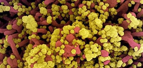 Colorized scanning electron micrograph of a cell heavily infected with SARS-CoV-2 virus particles (yellow), isolated from a patient sample. Image captured at the NIAID Integrated Research Facility (IRF) in Fort Detrick, Maryland. Credit: NIAID Colorized scanning electron micrograph of a cell heavily infected with SARS-CoV-2 virus particles (yellow), isolated from a patient sample. Image captured at the NIAID Integrated Research Facility (IRF) in Fort Detrick, Maryland. Credit: NIAID - ALLOW IMAGES